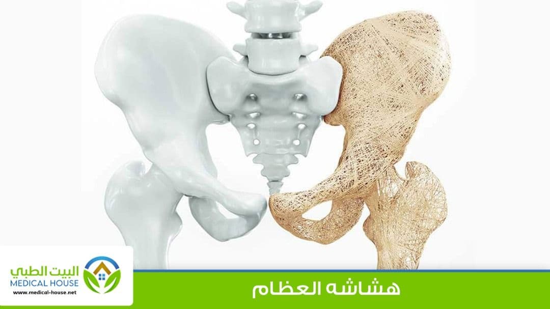 هشاشة العظام Osteoporosis