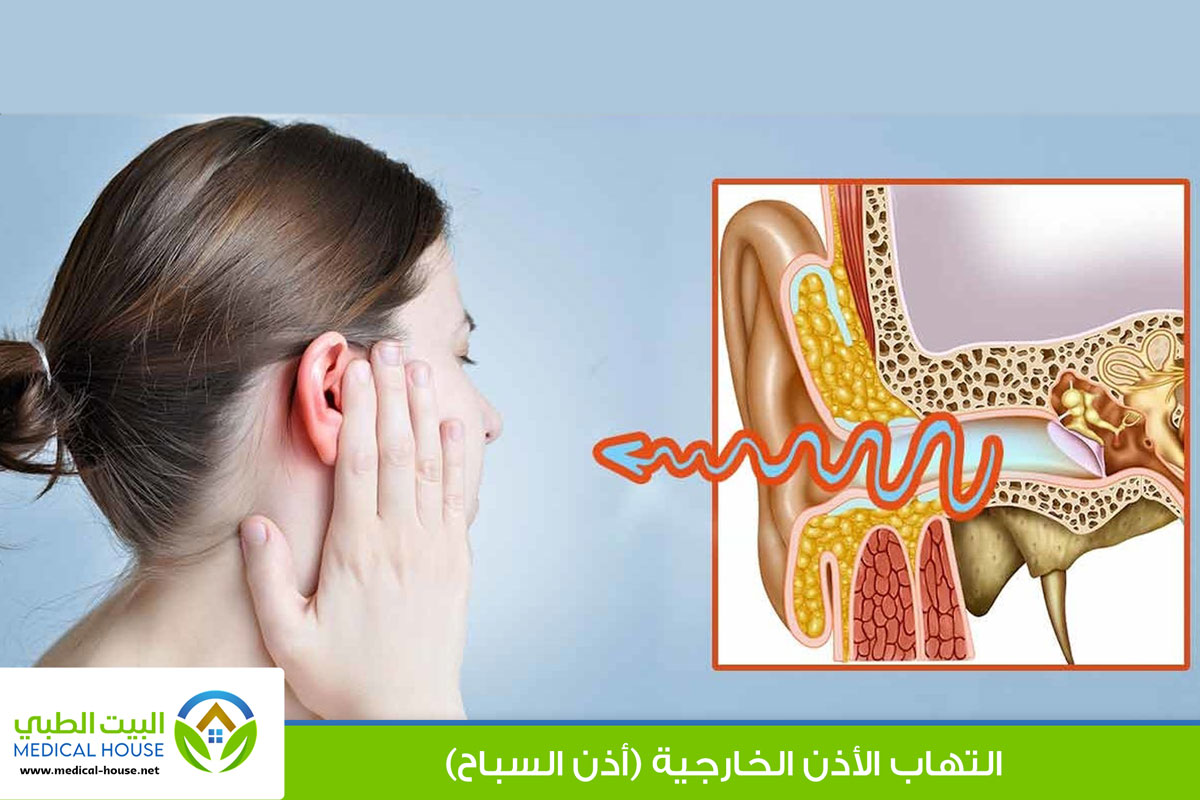 ما الذي تعرفه عن التهاب الأذن الخارجية (أذن السباح)