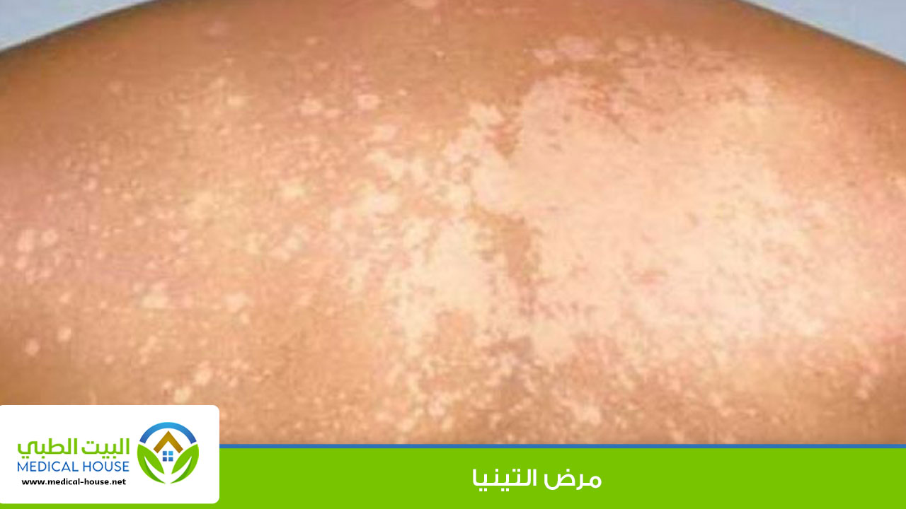 التينيا (السعفة) احد الامراض الفطرية الجلدية