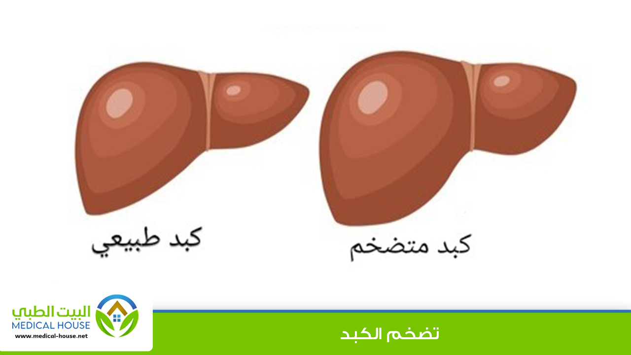 ما الذي يسبب تضخم الكبد؟