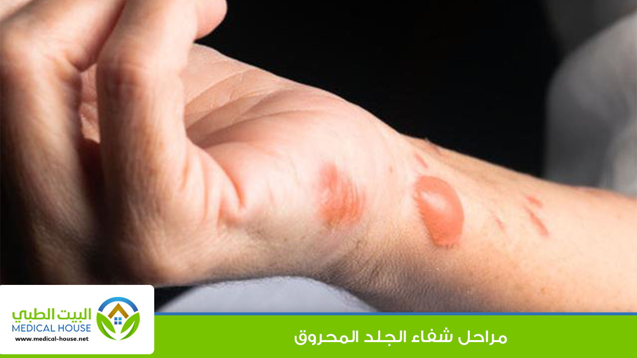 مراحل شفاء الجلد المحروق